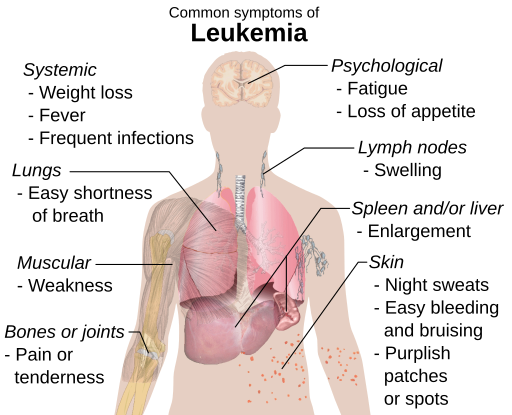 symptoms of leukaemia